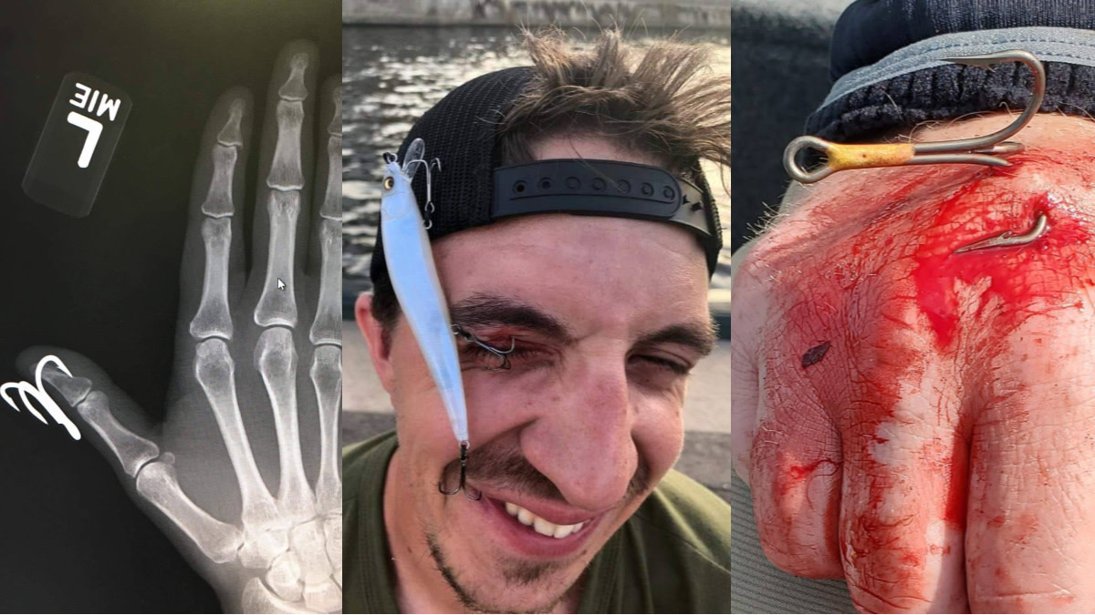 fishing hook accidents