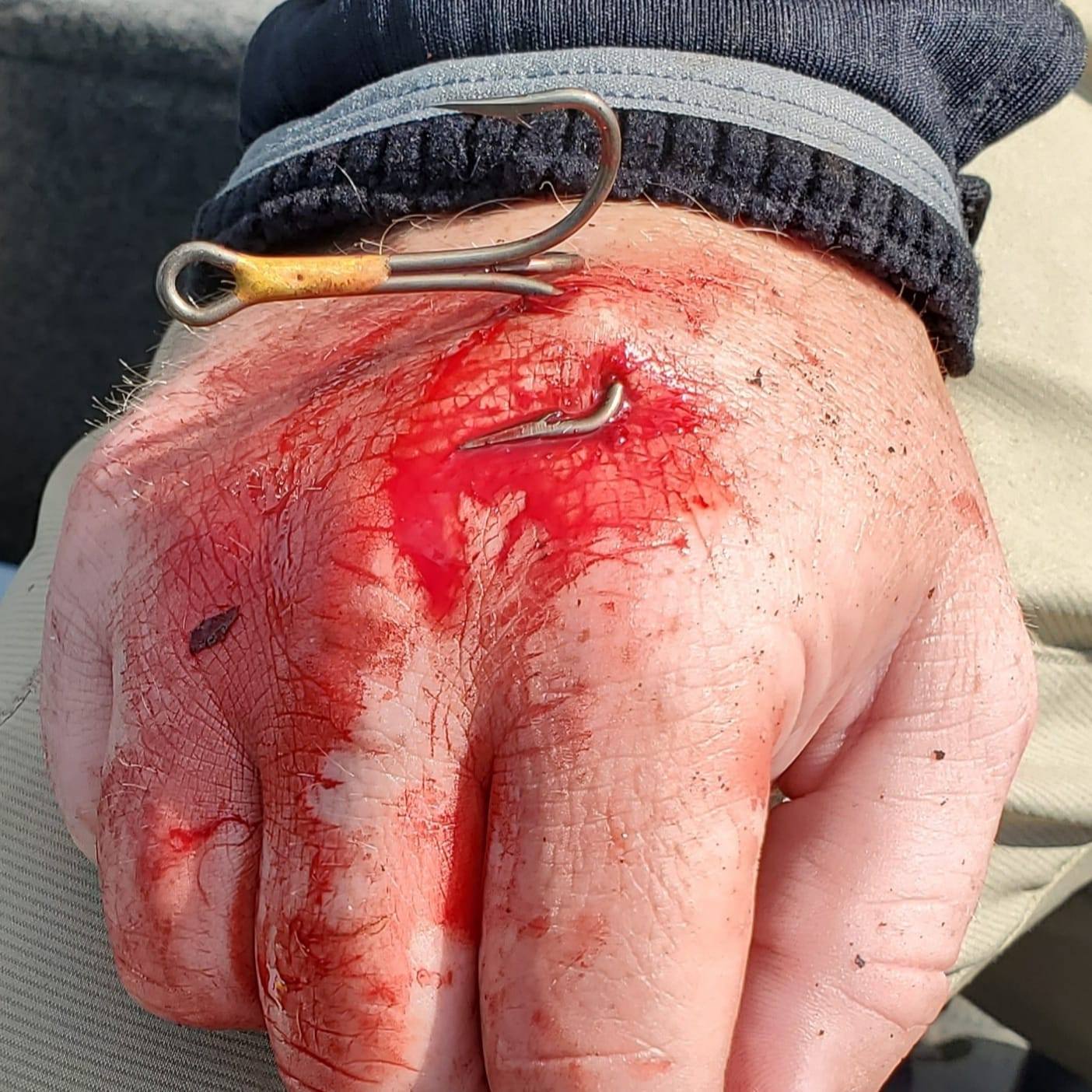 Photos: The Worst Fish Hook Injuries to MeatEater Fans