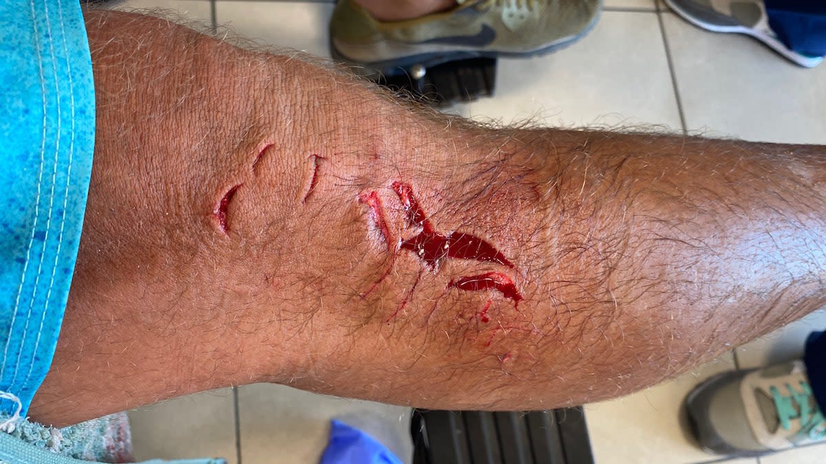Photos: Florida Man Attacked by Shark After Bite from Gator
