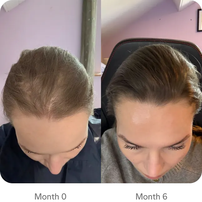 Woman with hair regrowth after 6 months