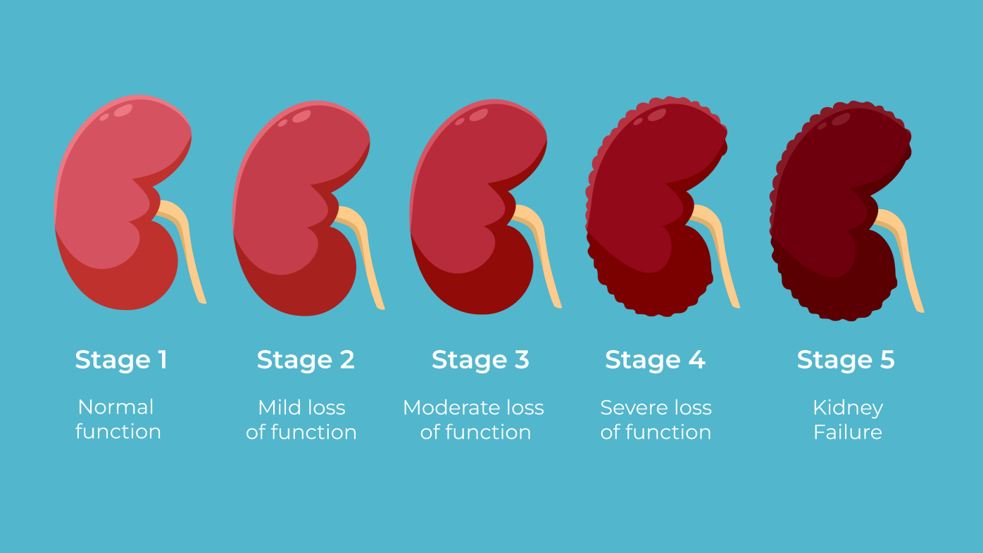 Illustration of the stages of chronic kidney disease