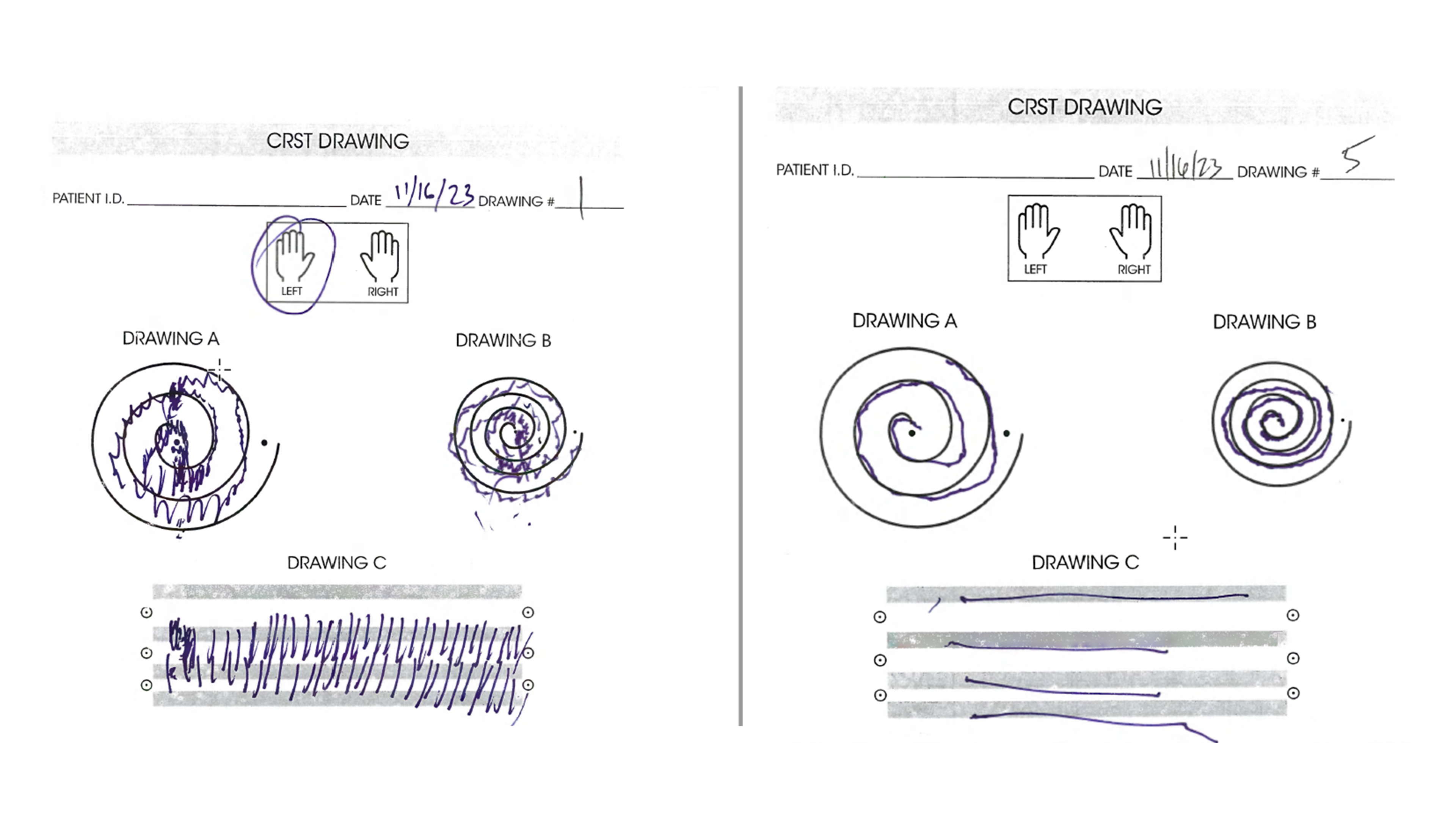 Drawing test for patient with Parkinson's