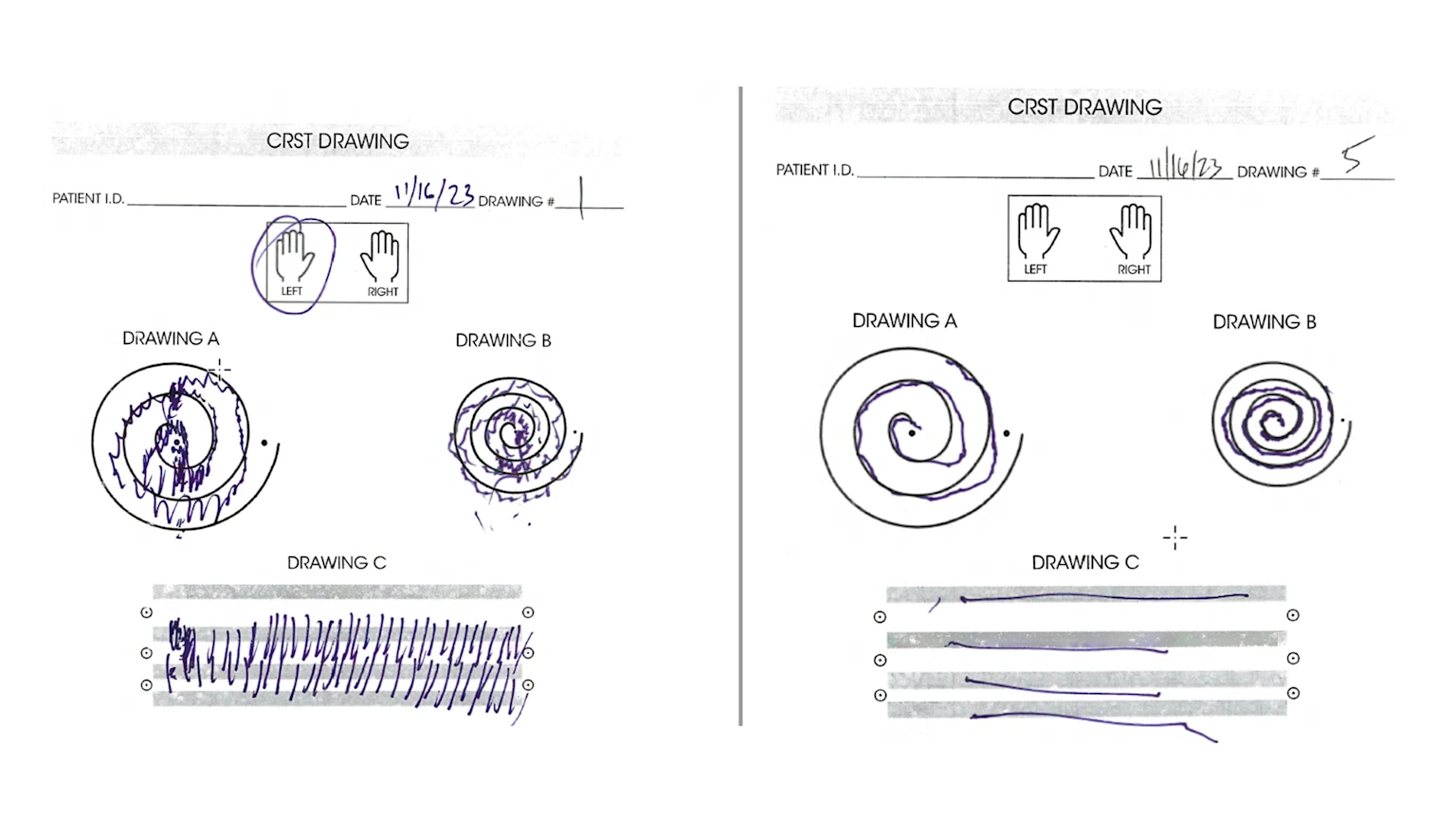 Drawing test for patient with Parkinson's
