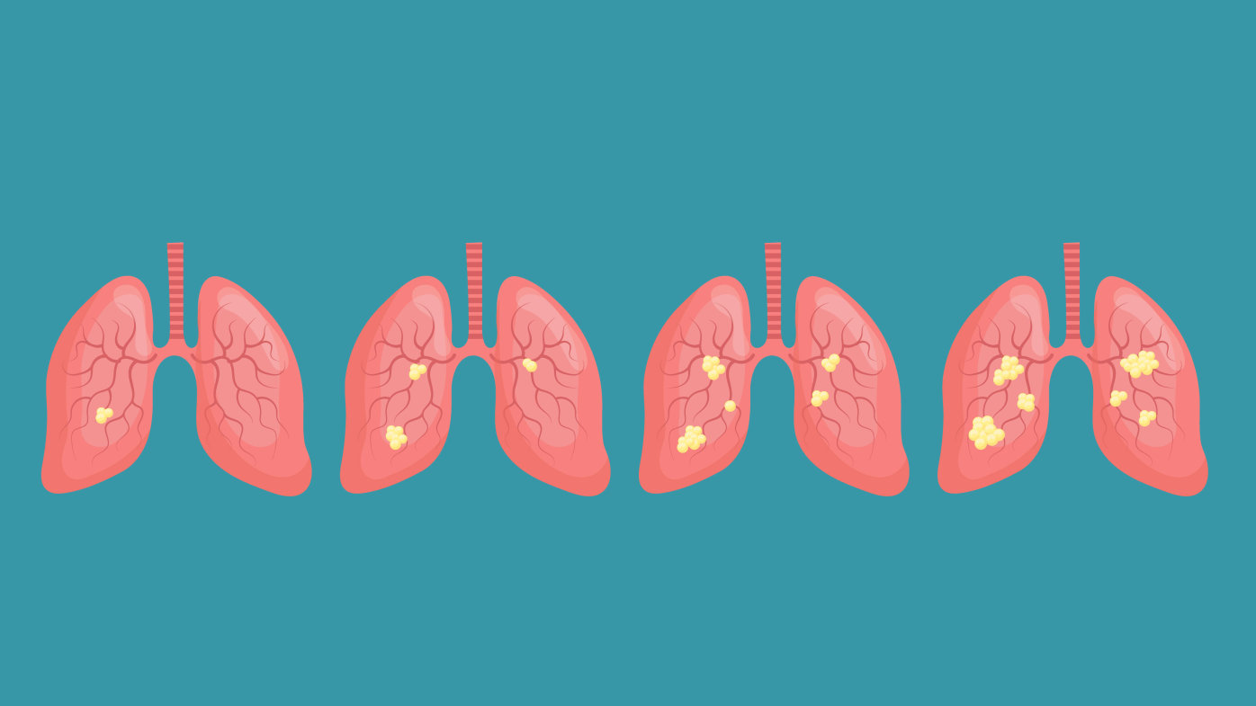 Illustration of lung cancer stages