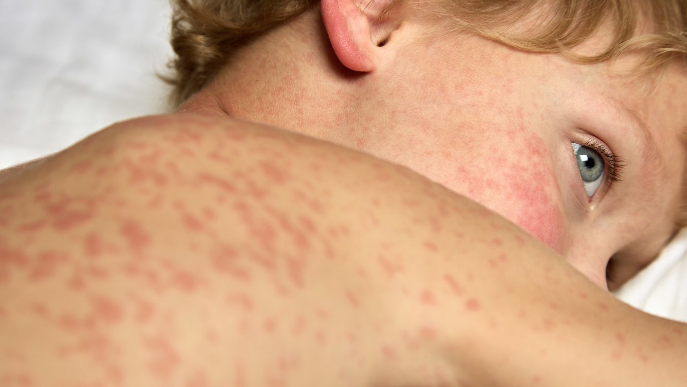 Child with rash