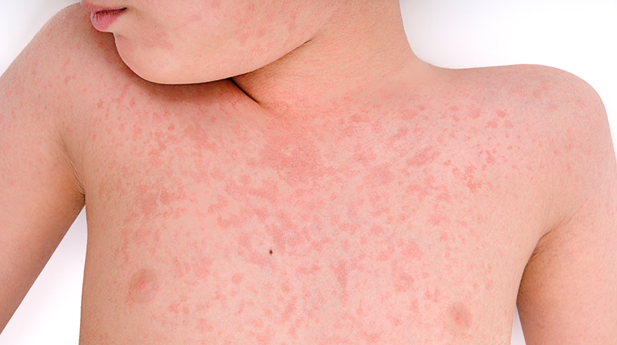 Do I Need to Get the Measles Vaccine? Sharp HealthCare