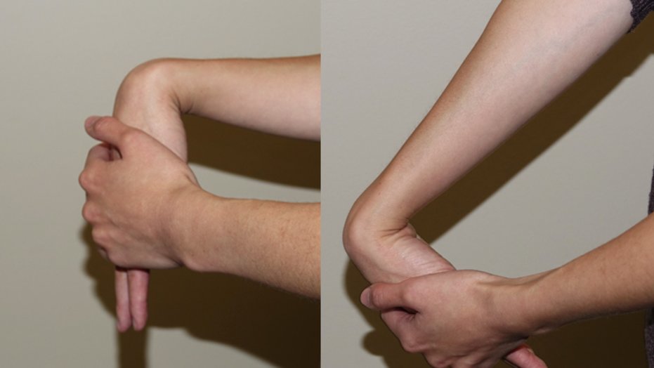 Preventing tennis elbow: Stretch variations