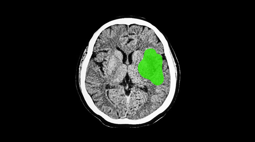 Brain imaging breakthrough provides new stroke care options