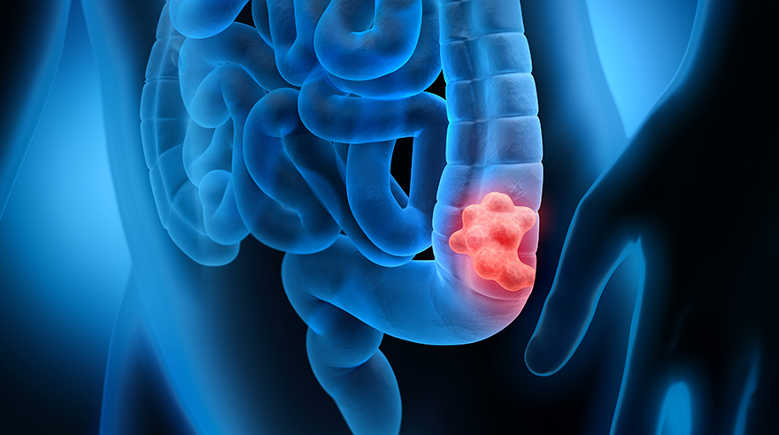 Which colorectal screening is right for you?
