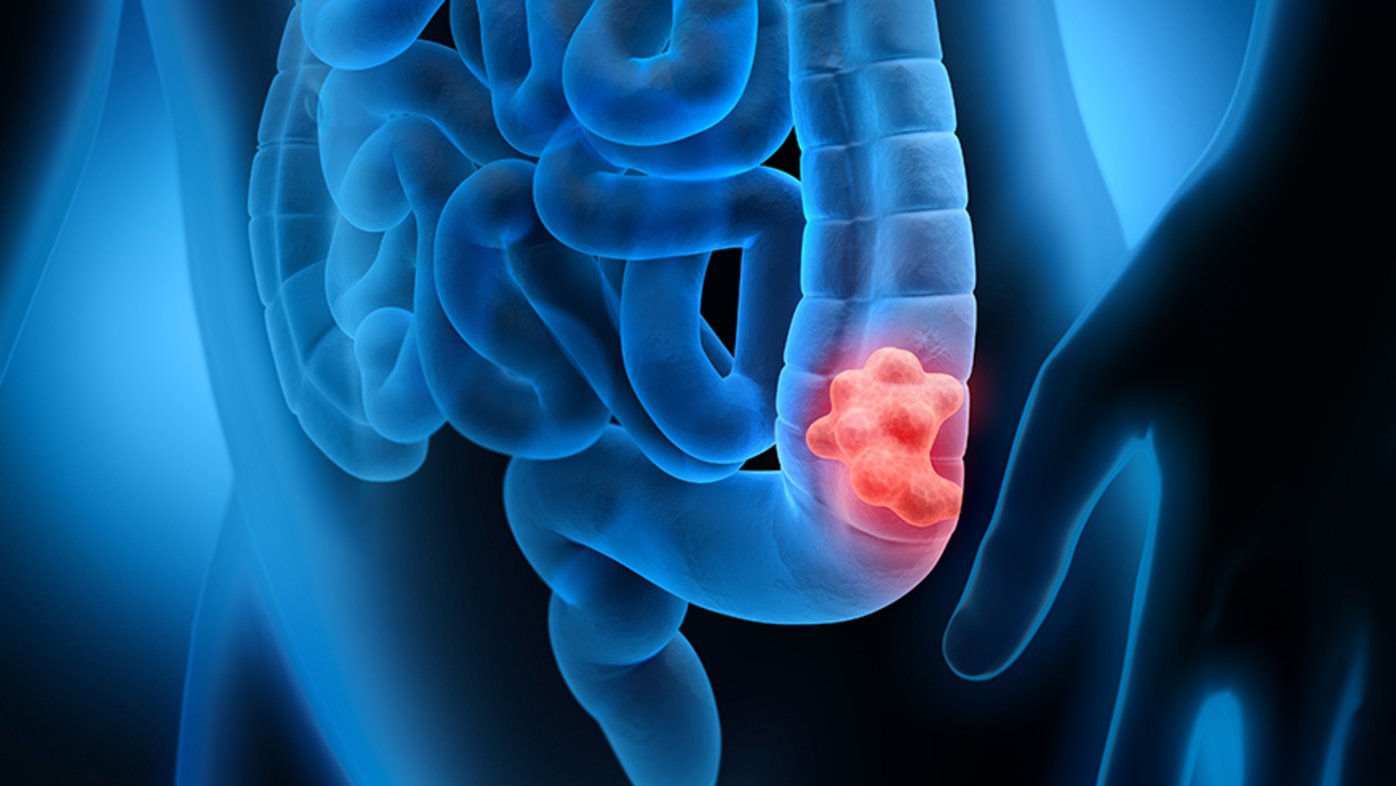 Which colorectal screening is right for you?