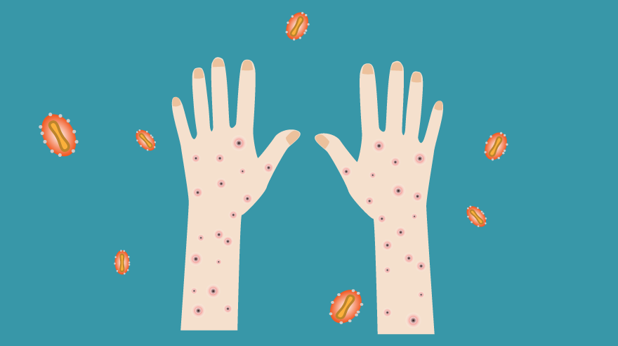 Illustration of hands with Monkeypox spots