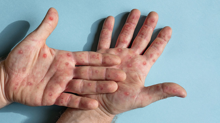 Hands with monkeypox
