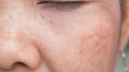 Can You Repair Sun Damaged Skin Sharp HealthCare