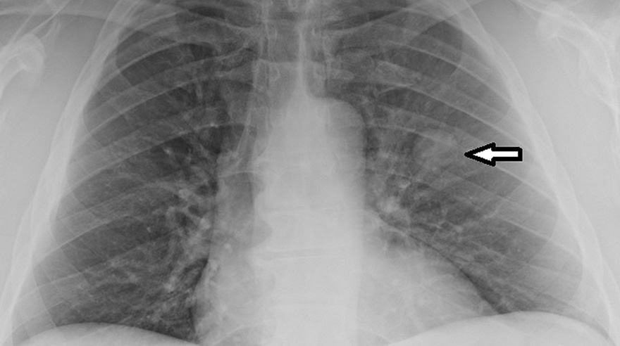 What Do Lung Nodules Look Like On Ct Scan Ct Scan Machine