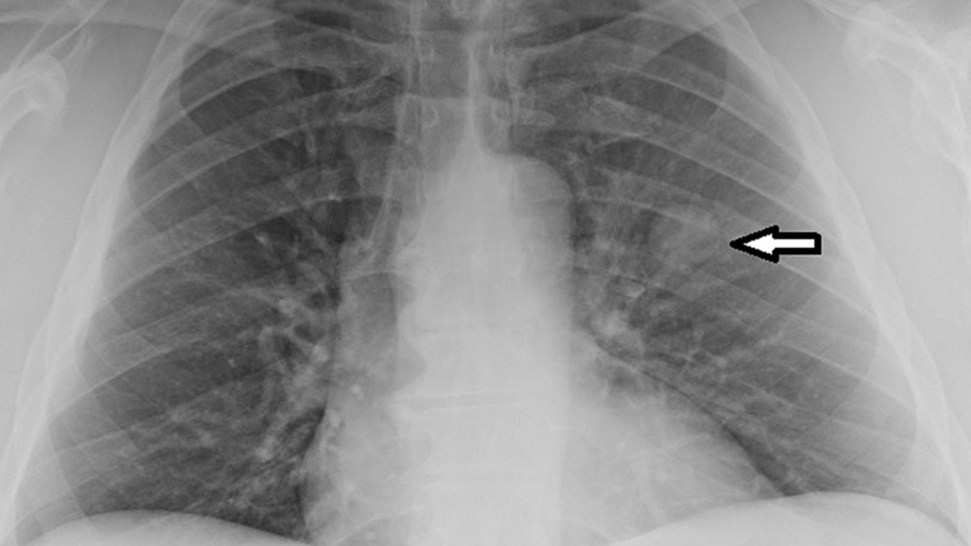 X-ray image of lungs