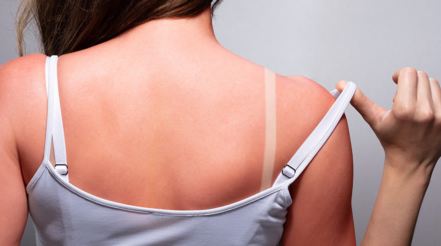 How To Naturally Cure Sunburn