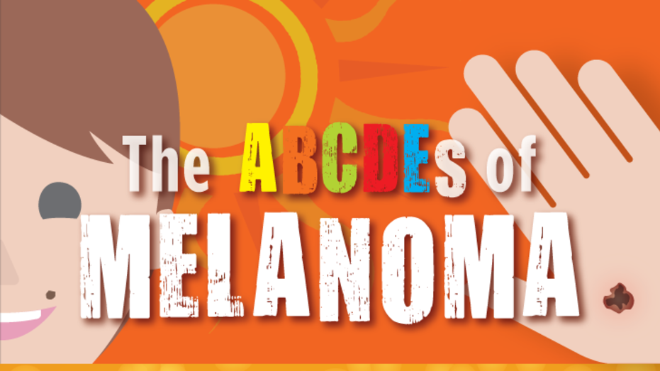 ABCDEs of melanoma