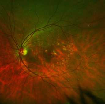 Dry macular degeneration with numerous drusen in the macula.
