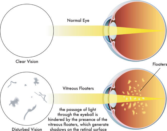 Floaters and Flashers Graphic