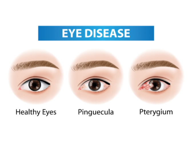 Eye Disease Graphic with Healthy Eyes, Pinguecula, and Pterygium
