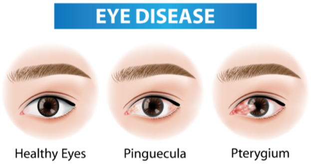 Eye Disease Graphic with Healthy Eyes, Pinguecula, and Pterygium