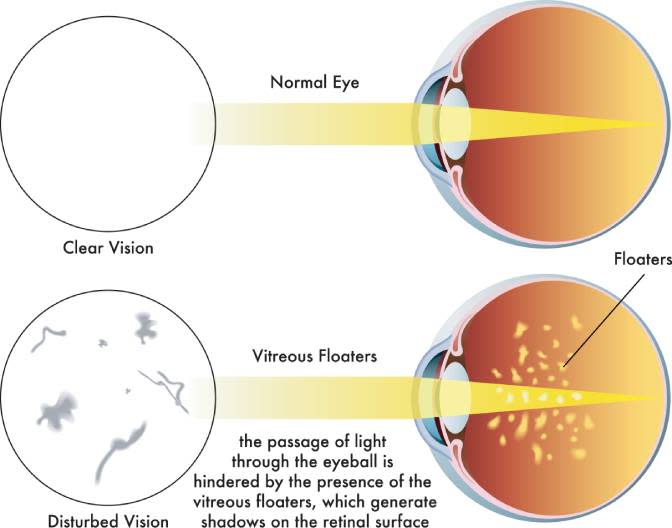 Eye Floaters Image