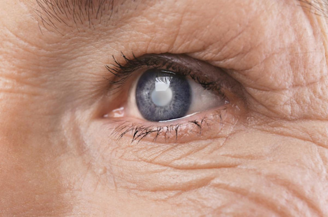 nwv cataracts example