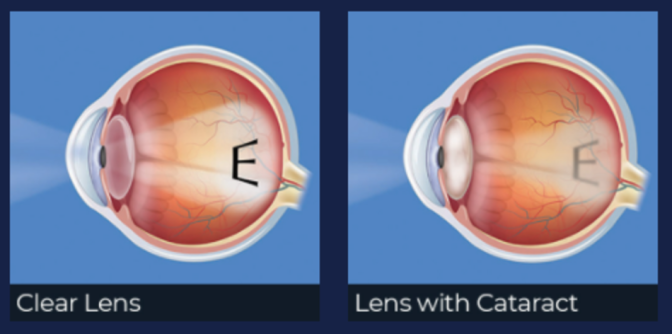 Clear lens versus lens with cataract