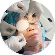 OPT-Service-Cataract-DayOf-circle4