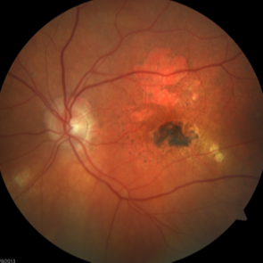 Treated wet macular degeneration with heave atrophic areas and scar tissue formation.