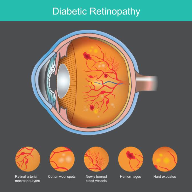 Diabetic retinopathy screening