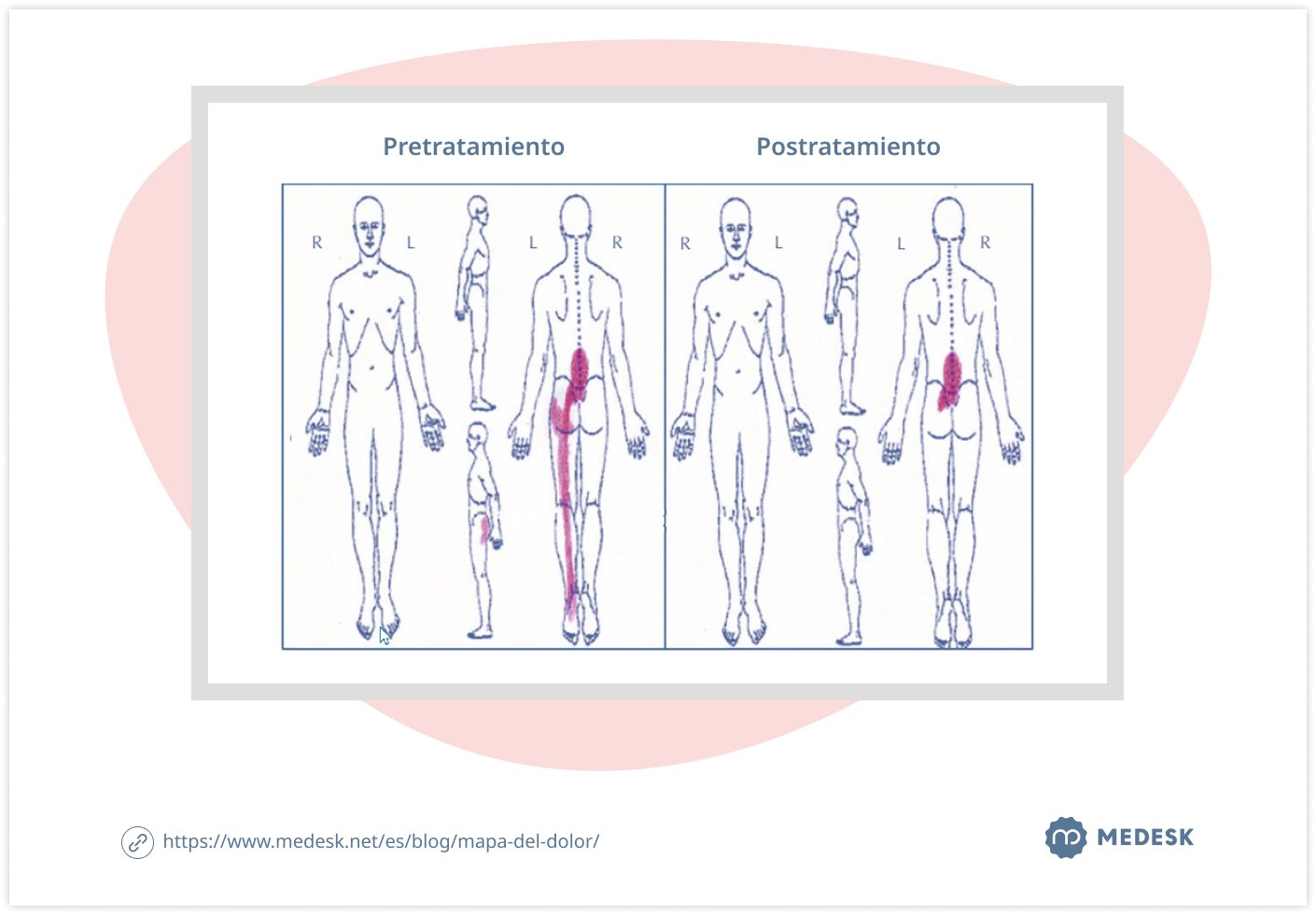 mapa-del-dolor-body-chart-1