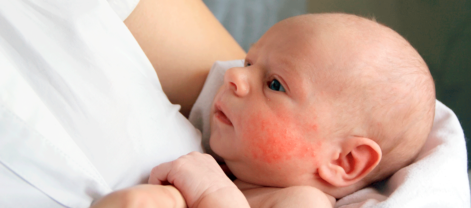 fotografie Oven Praten Baby acne: oorzaken, behandeling | Pampers NL