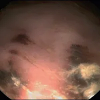 Benefits of Beet-pulp for Ulcers