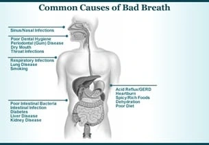 common cause of bad breath