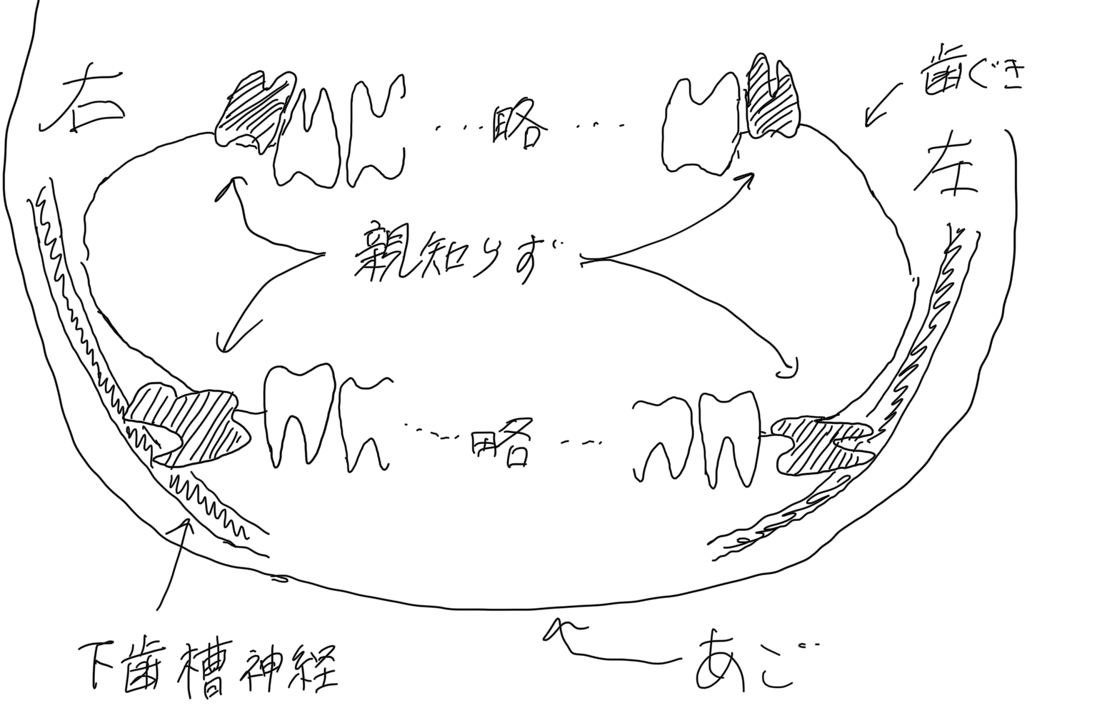 歯茎 剥がれる 親知らず