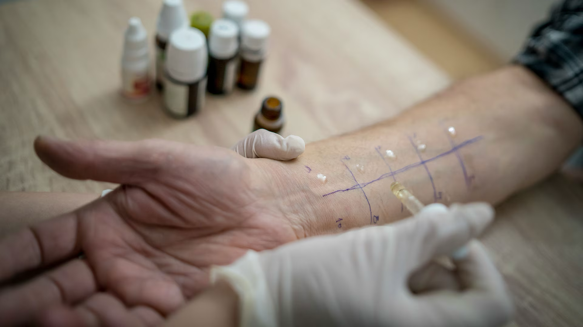 person getting a food allergy test