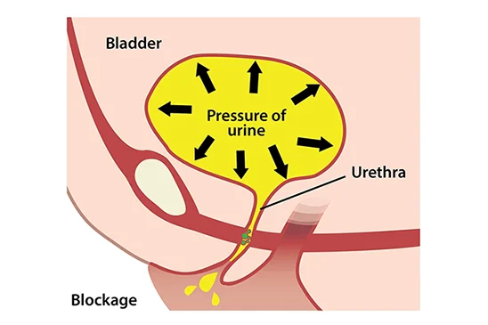 Illustration of overflow incontinence
