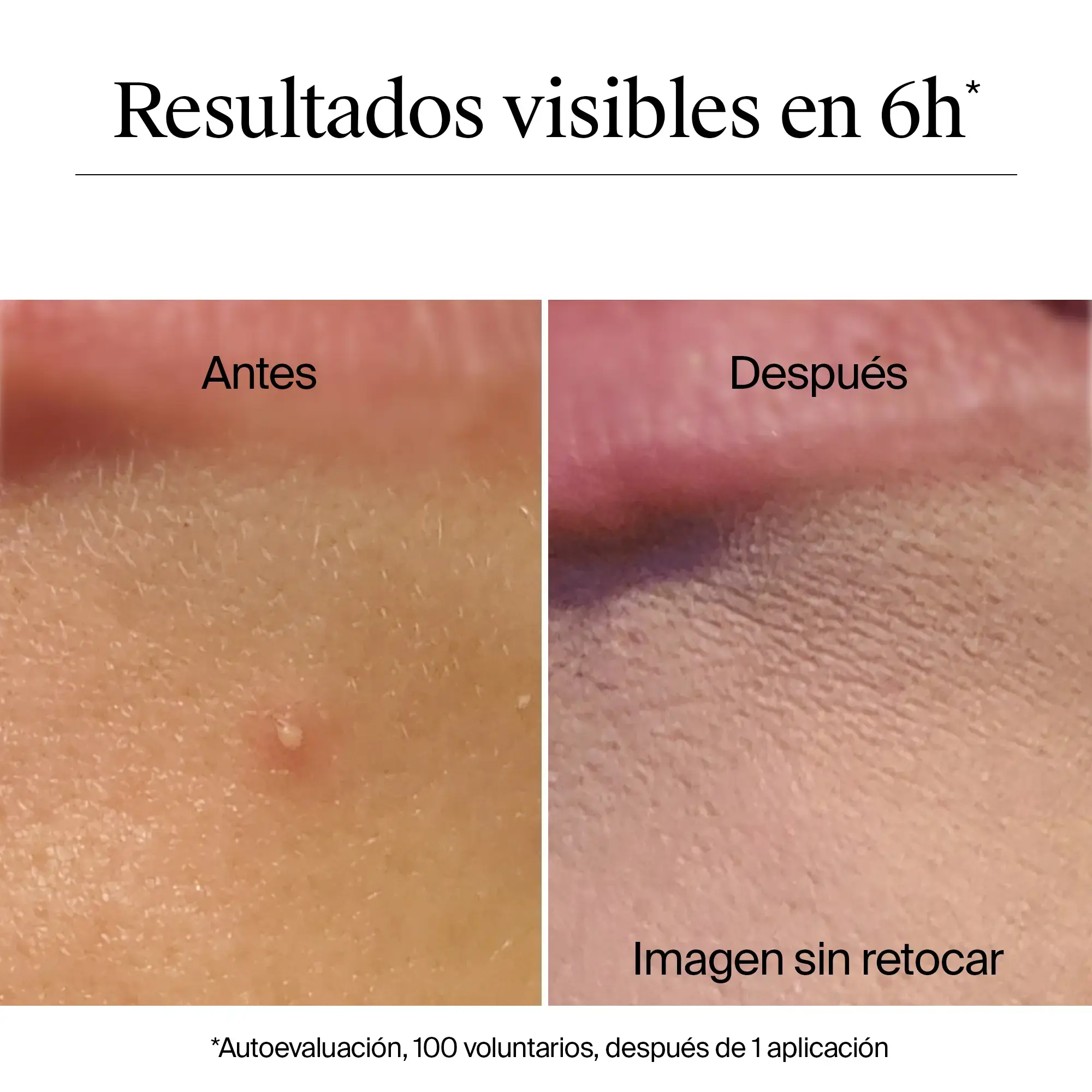 Clear & Defend+ Parches para Imperfecciones Piel Sensible