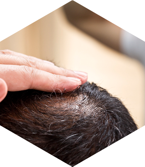 La caída del pelo en hombres