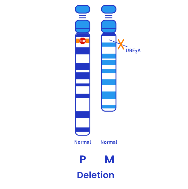 A deletion removes the maternal copy of the UBE3A gene in individuals living with Angelman syndrome. 