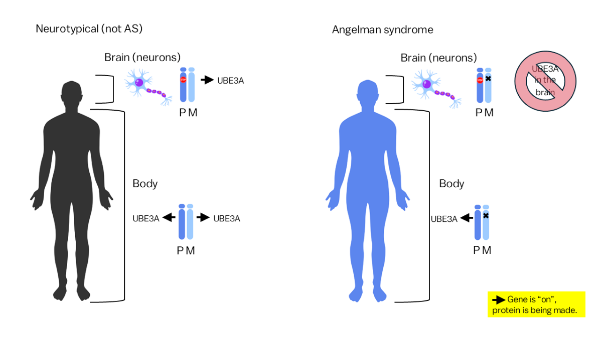 Image showing neurotypical vs Angelman syndrome and UBE3A protein being made.