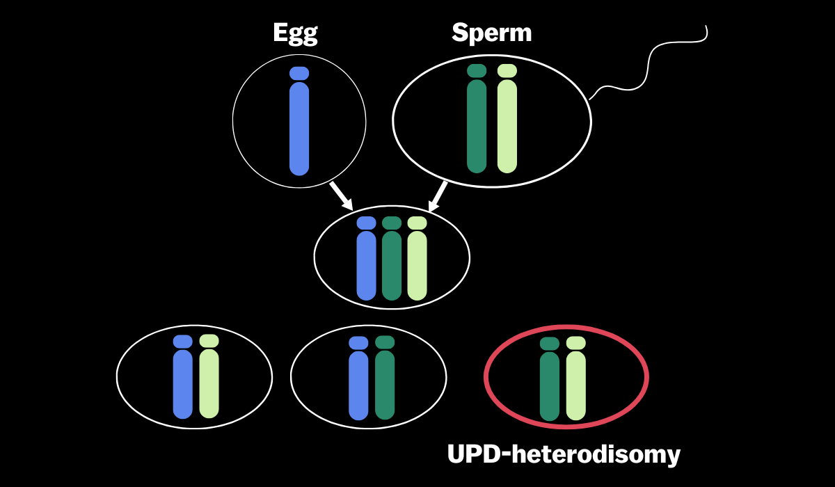 Image showing sperm with extra chromosome, resulting in UPD in the embryo.  