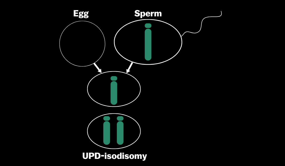 Image showing egg missing a chromosome, resulting in an embryo with a duplicated chromosome and UPD  