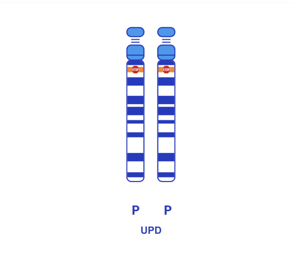 Uniparental disomy (UPD) is when both copies of a chromosome pair came from one parent, instead of the usual one chromosome from the egg, one chromosome from the sperm.