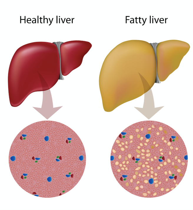 fatty liver