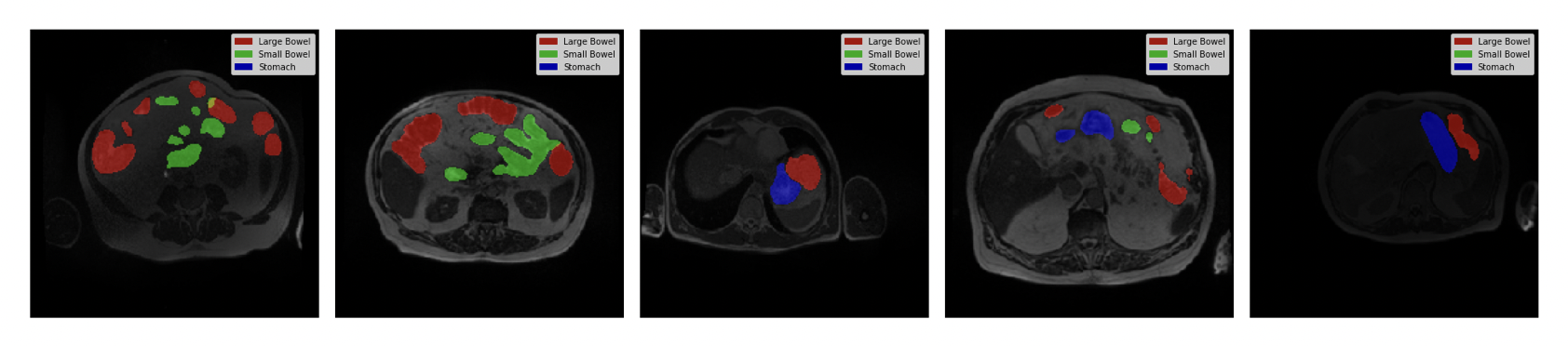 UWMGI Dataset Visualization