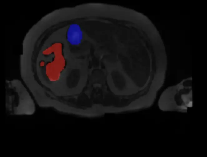 Radiology Machine Learning. Multi-Image Segmentation with TransUNet