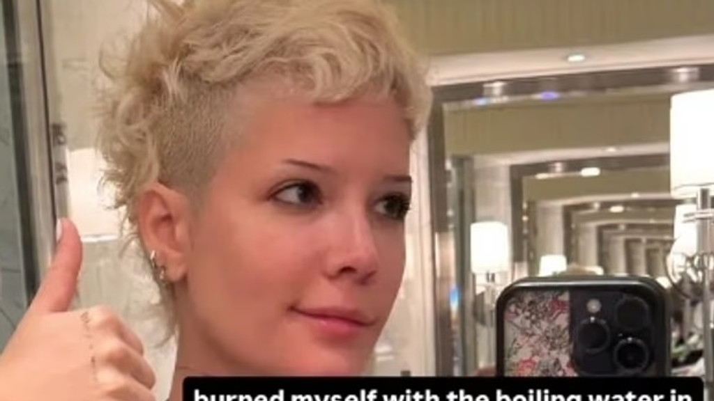 Halsey covered in bandages after suffering painful burns