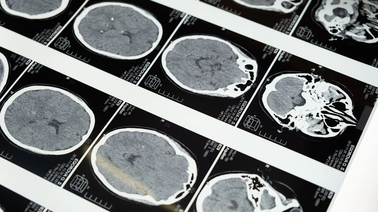 A close-up, angled shot of multiple medical CT scans of a human brain, displayed on a film with white text overlays, showing various axial cross-sections.